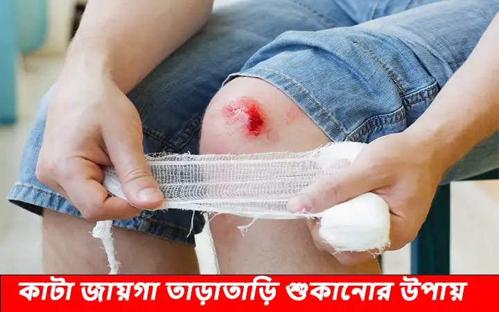 কাটা জায়গা তাড়াতাড়ি শুকানোর উপায়